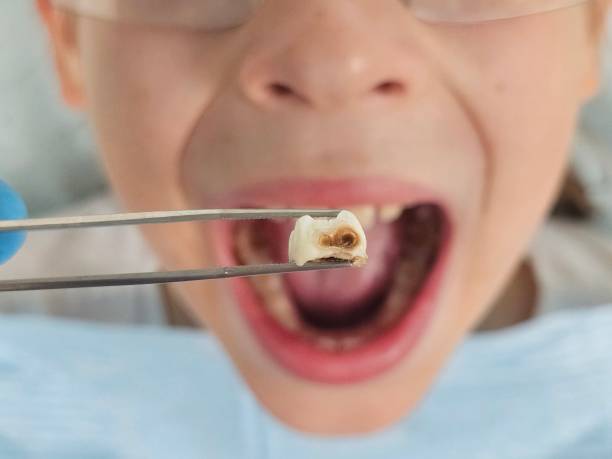 Best Emergency Root Canal Therapy in Westport, NC